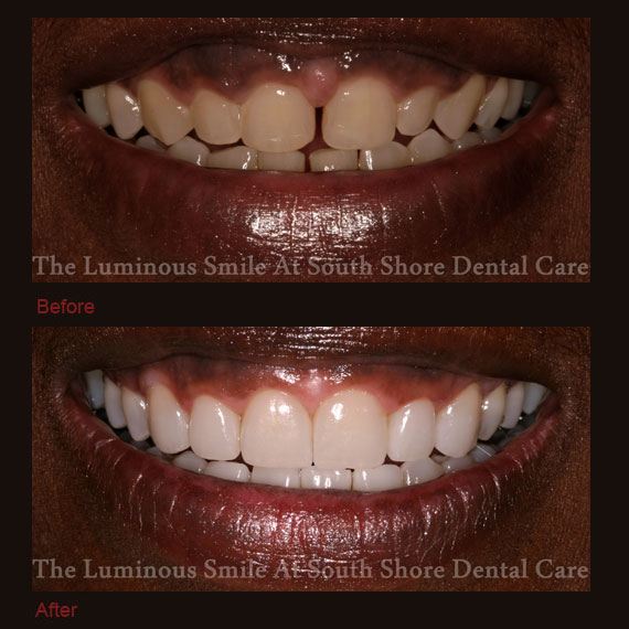 Before and after gap between teeth and flawless lumineers