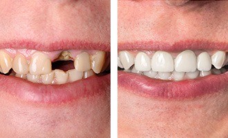 Before and after images of patient with missing tooth