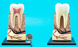 a model of a tooth’s roots showing how root canal therapy in Massapequa Park works