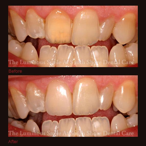 Yellow front tooth repaired with bonding