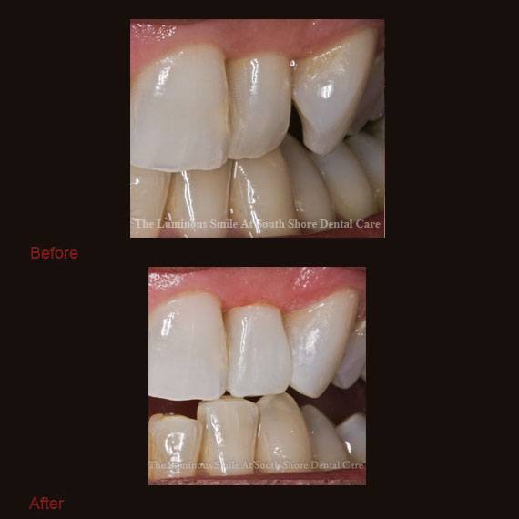 Oddly shaped tooth and bonding repair