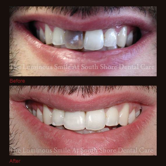 Dark black front tooth repaired with bonding