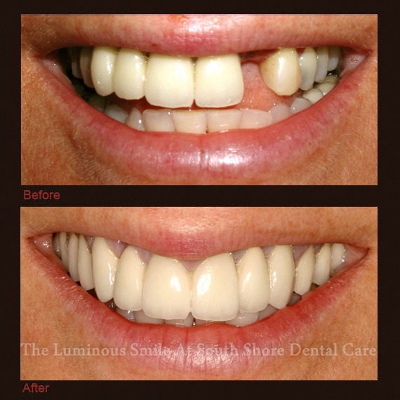 Before and after images missing tooth and porcelain veneers