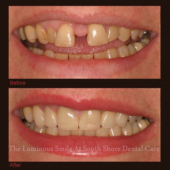 Damaged and discolored teeth repaired with dental crowns