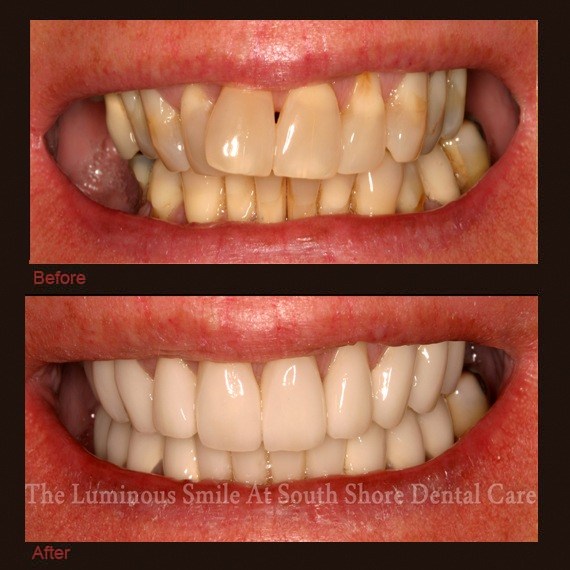 Before and after images discolored decayed teeth and porcelain veneers