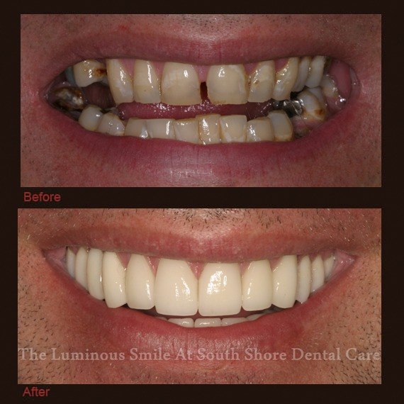 Severely gapped front teeth repaired with dental crowns