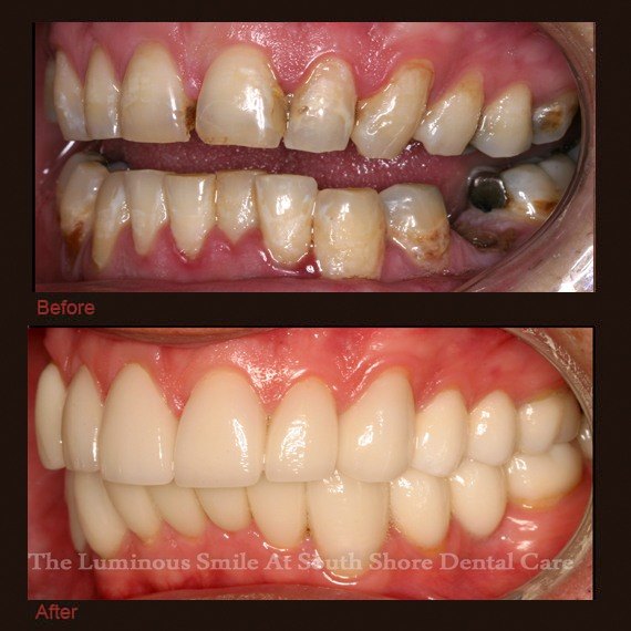 Before and after images decayed damaged smile and veneer treatment