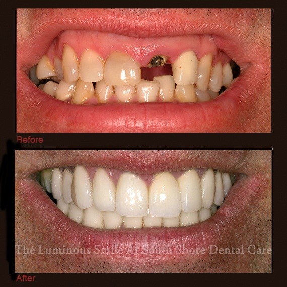 Before and after images missing tooth and veneers