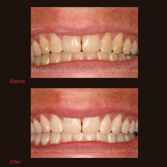 Yellow teeth and bright smile following whitening