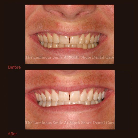 Discolored teeth and flawless teeth whitening results