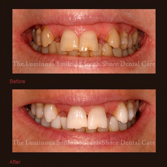 Severely discolored teeth and white smile after teeth whitening