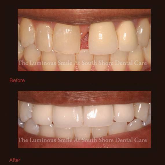 Gapped and yellowed teeth and bright smile following teeth whitening