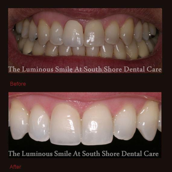 Before and after dark front tooth and veneer repair