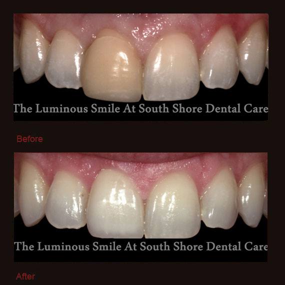 Before and after yellow front tooth and veneer repair