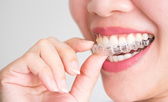 Nose-to-chin view of woman removing Invisalign from upper arch