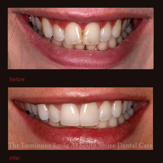 Decayed front teeth and veneer repair