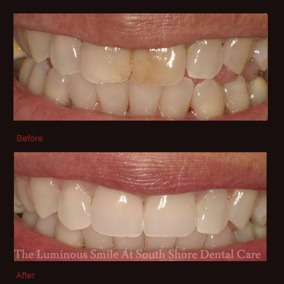 Yellow and damaged front teeth and veneer repair