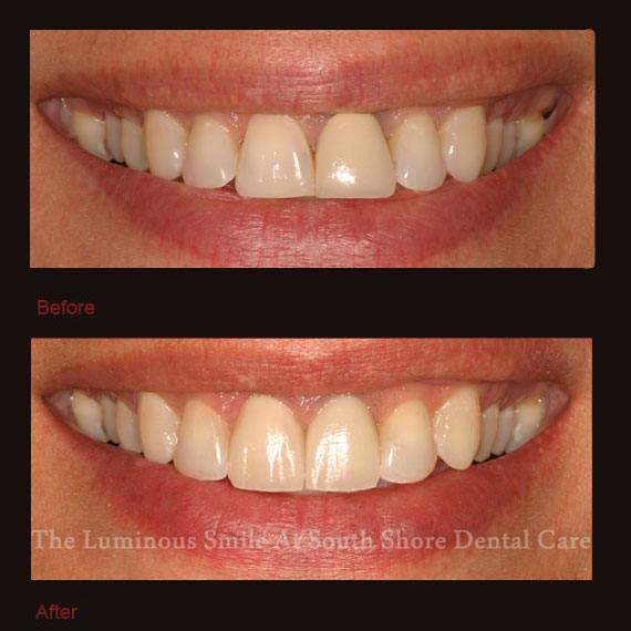 Front teeth with damage and veneer repair