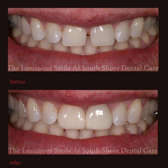 Gap between front teeth and veneer repair