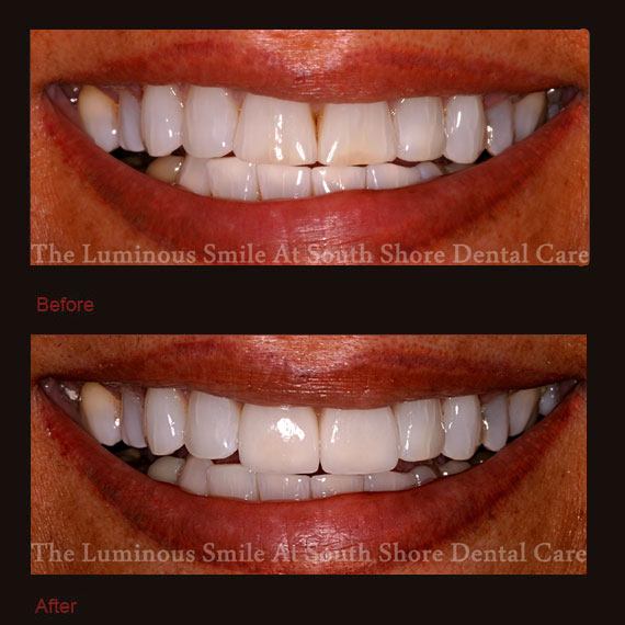 Damaged front teeth and veneer repair