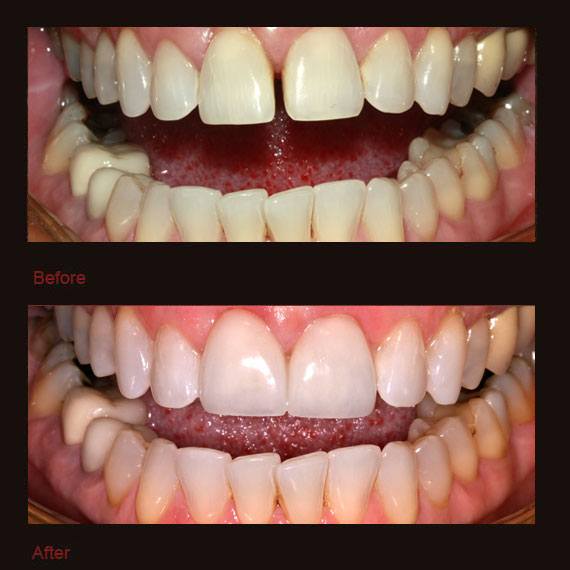 Large gap between front teeth and veneer repair