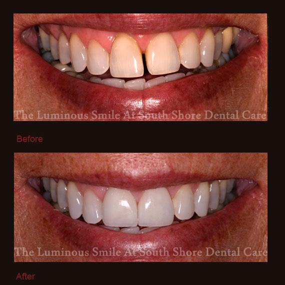 Unevenly spaced teeth and veneer repair