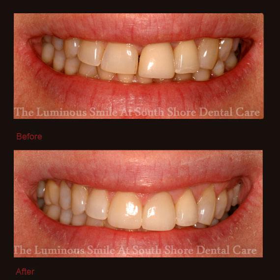 Discolored damaged front teeth and veneer repair