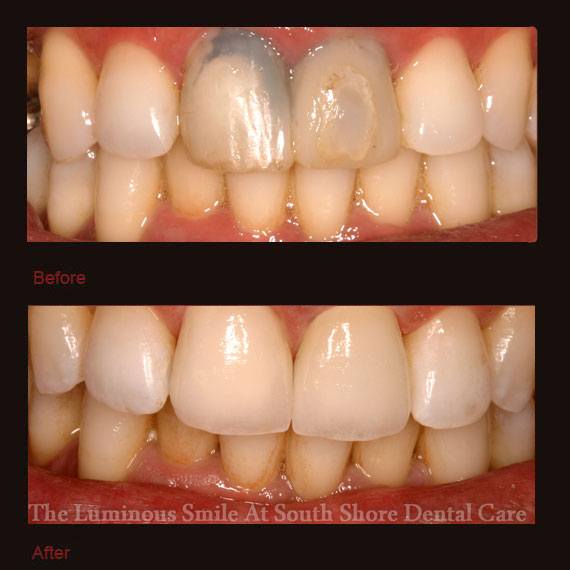 Gray and damaged front teeth and veneer repair
