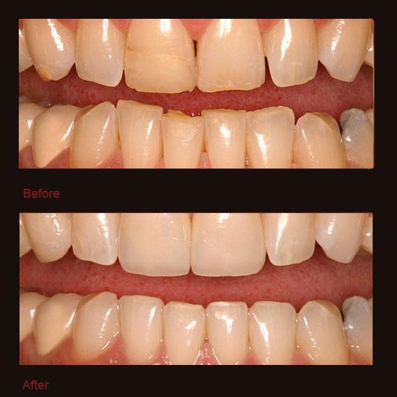 Worn front teeth and veneer repair