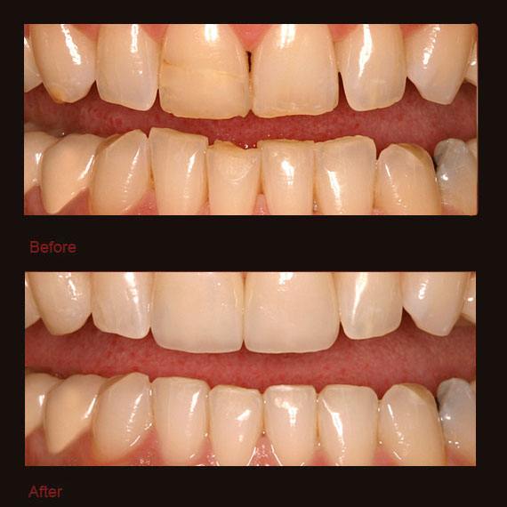 Worn front teeth and veneer repair
