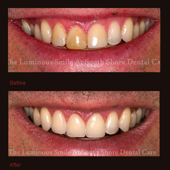 Yellow three front teeth and veneer repair
