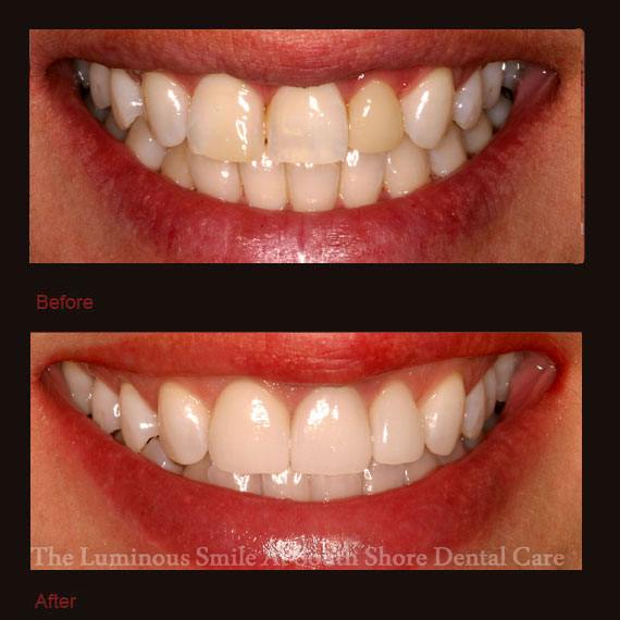 Discolored three front teeth and veneer repair