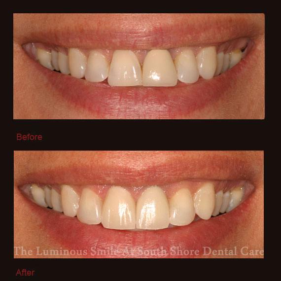 Damaged four front teeth and veneer repair