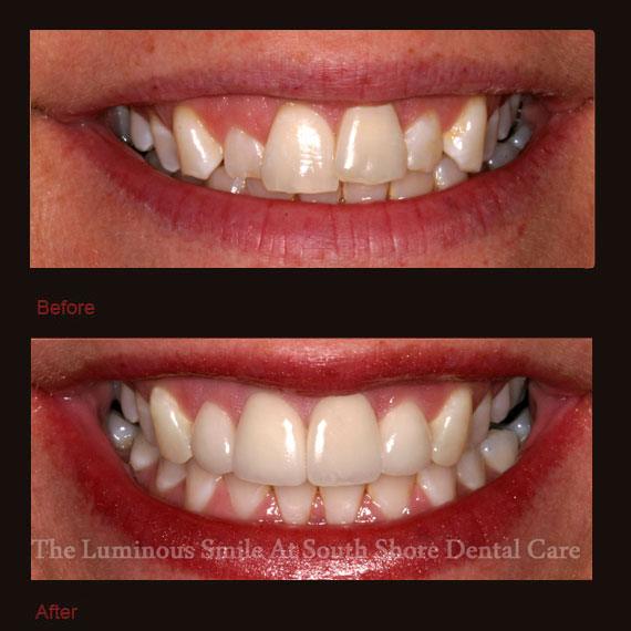 Unevenly sized front teeth and veneer repair
