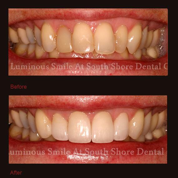 Severely discolored four front teeth and veneer repair