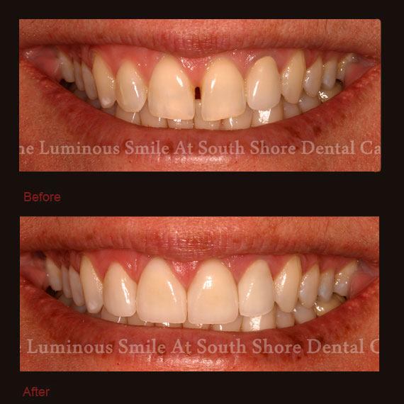 Large gaps between front teeth and veneer repair