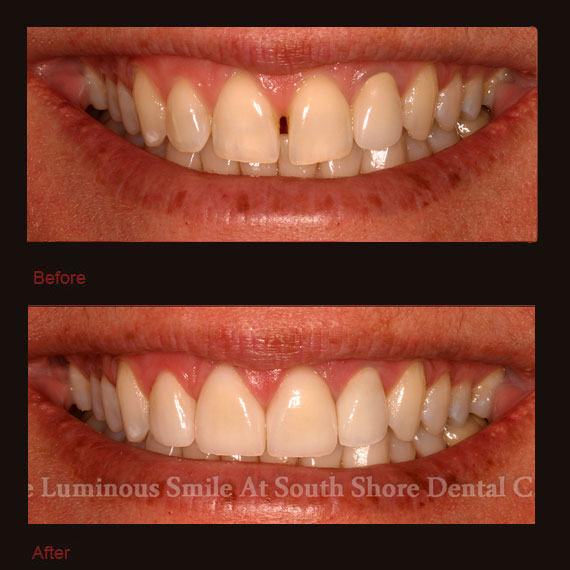 Unevenly spaced front teeth and veneer repair