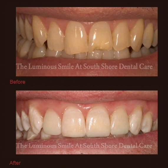 Chipped and cracked front teeth repaired with bonding