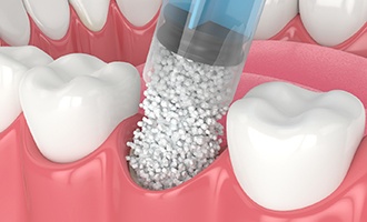 Bone grafting in Massapequa Park