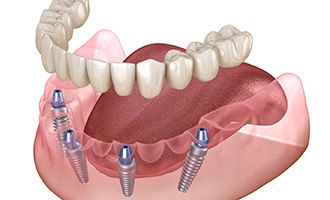 A digital image of All-On-4 dental implants in Massapequa