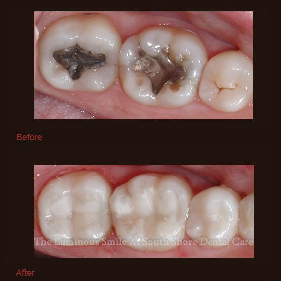 Two teeth with metal fillings repaired with bonding