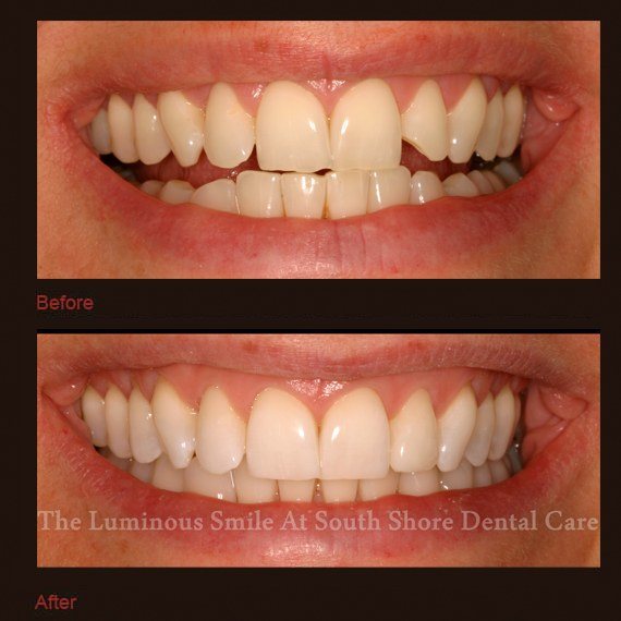 Irregularly shaped teeth repaired with bonding