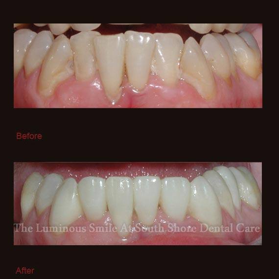 Discolored bottom teeth repaired with bonding