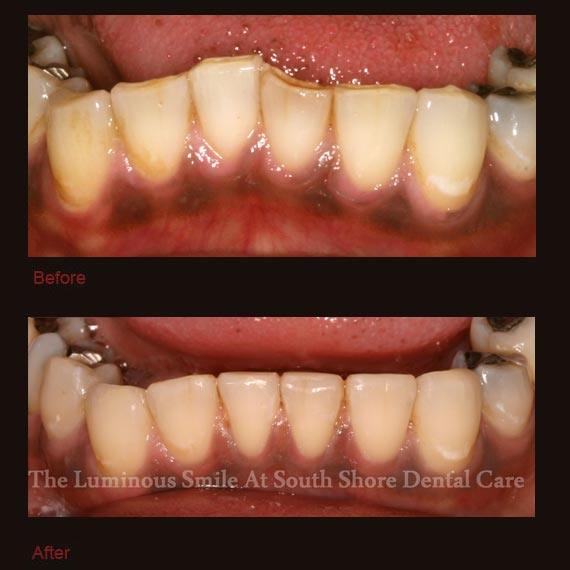 Worn bottom teeth repaired with bonding