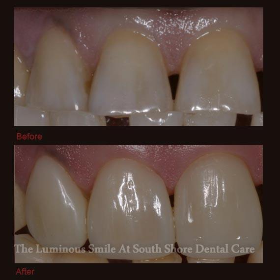 Misshapen teeth repaired with bonding