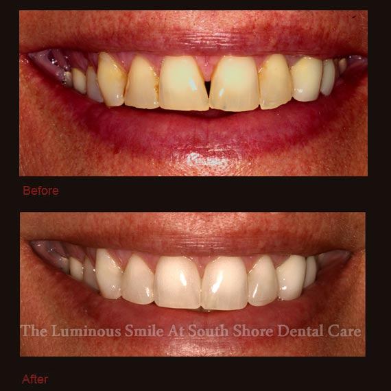 Dark yellow gapped teeth repaired with bonding
