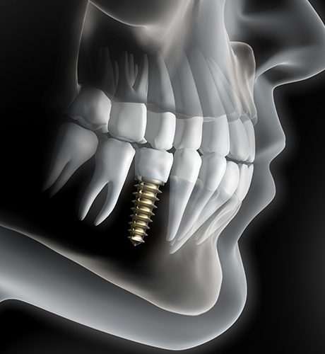 Animated X ray of a person with a dental implant in their lower jaw
