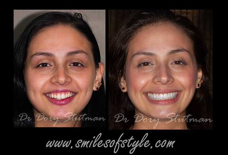 Young woman before and after treatment