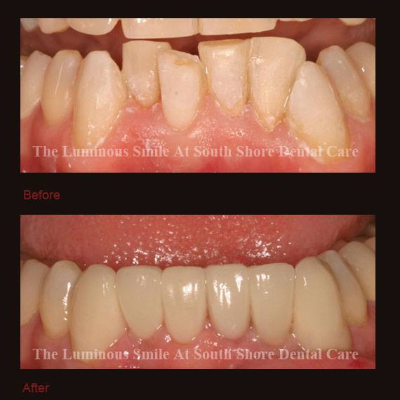 Gummy bottom teeth and recountouring