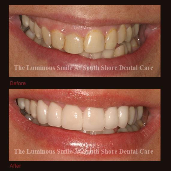 Uneven gum line and recontouring